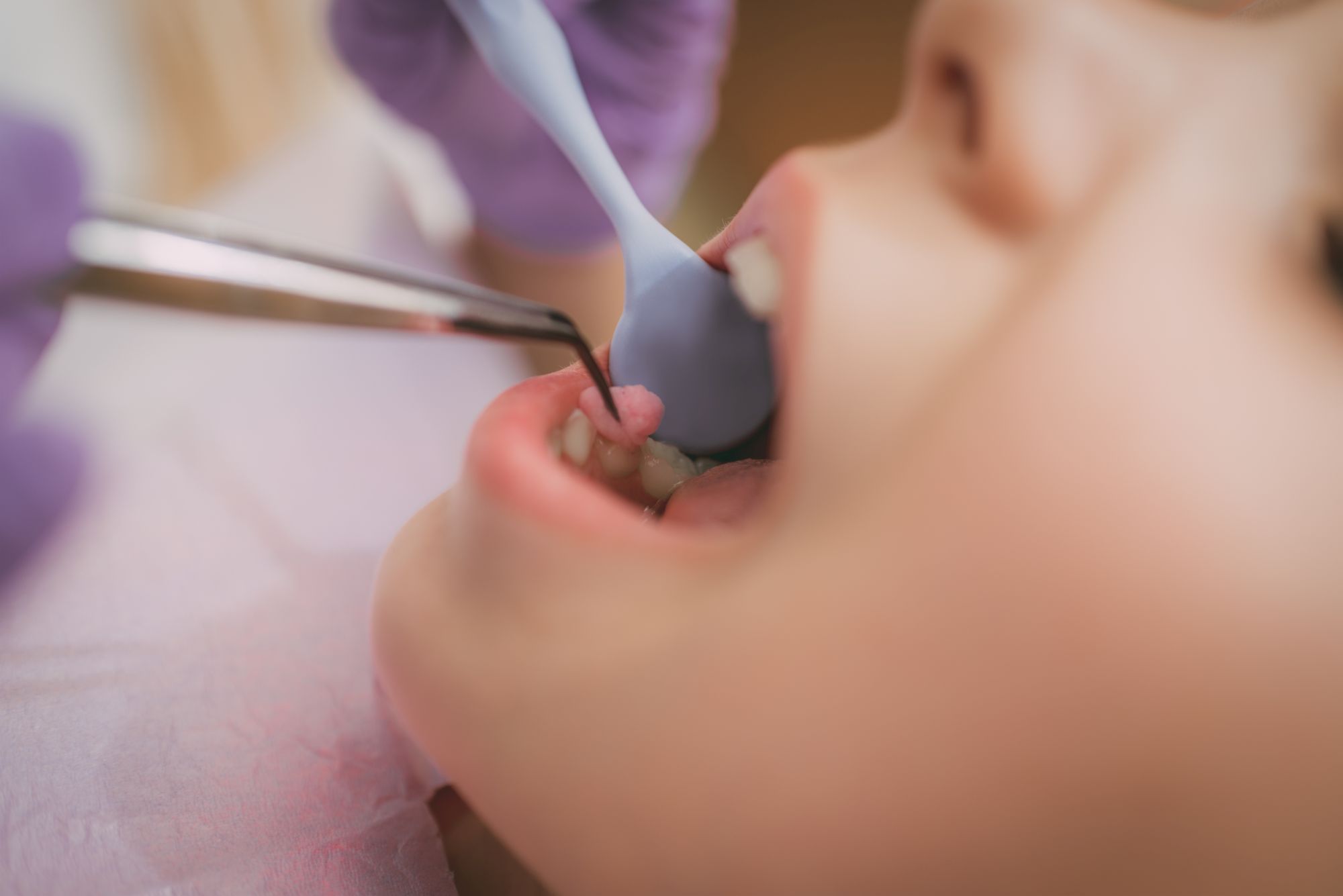 What is the White Stuff in a Canker Sore?